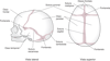 Suturas cranianas (calvária)