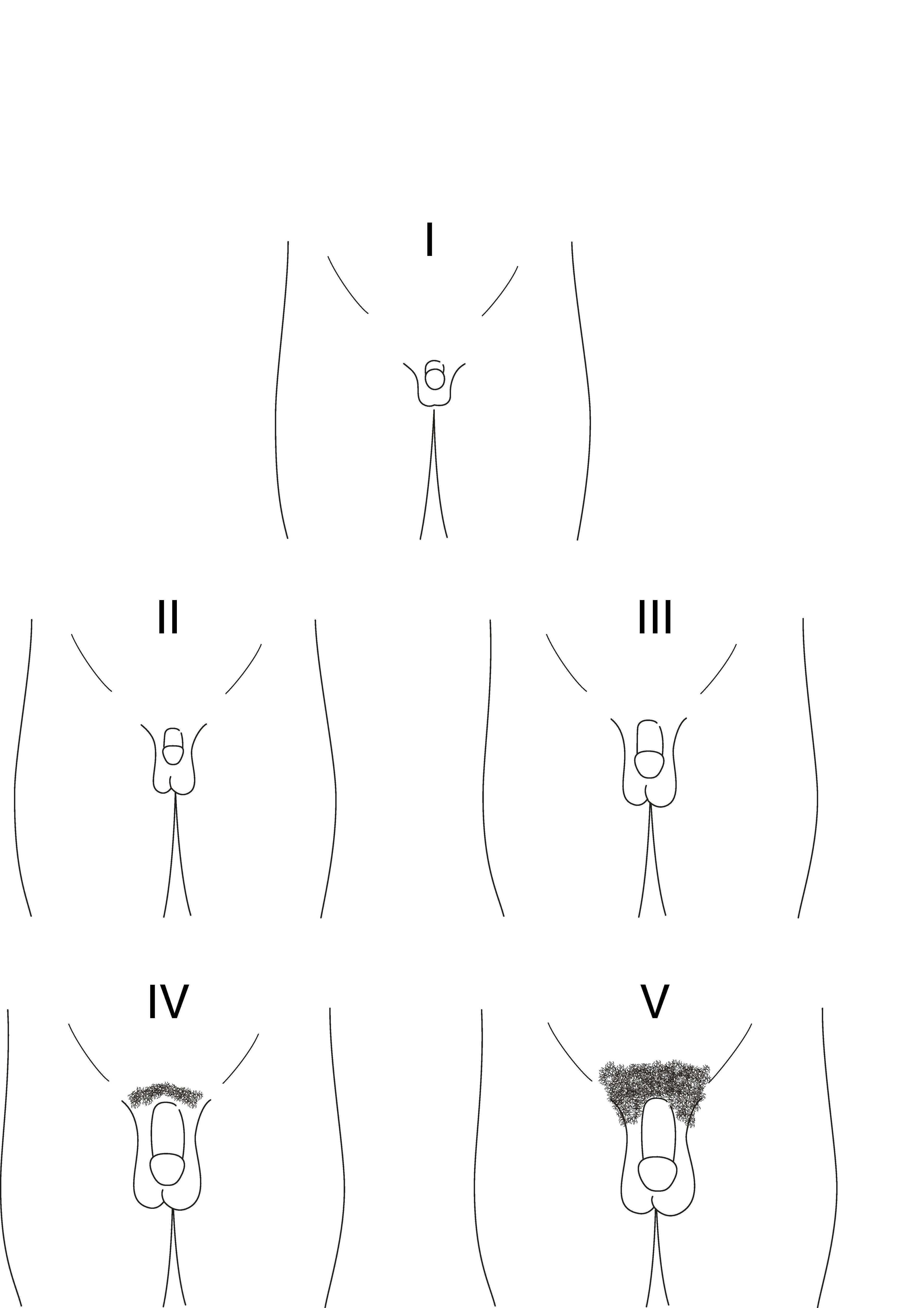 Representação diagramática dos estágios I a V de Tanner para o desenvolvimento do pênis em meninos