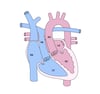 Kongenital korrigierte Transposition der großen Arterien (CCTGA)