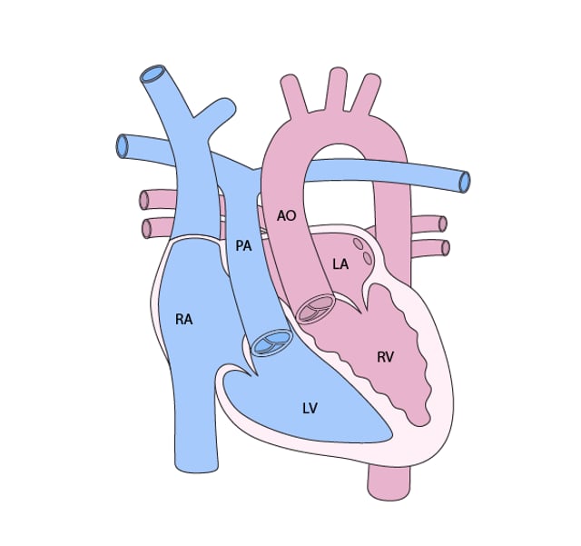 Image:Transposición corregida congénitamente de las grandes arterias ...