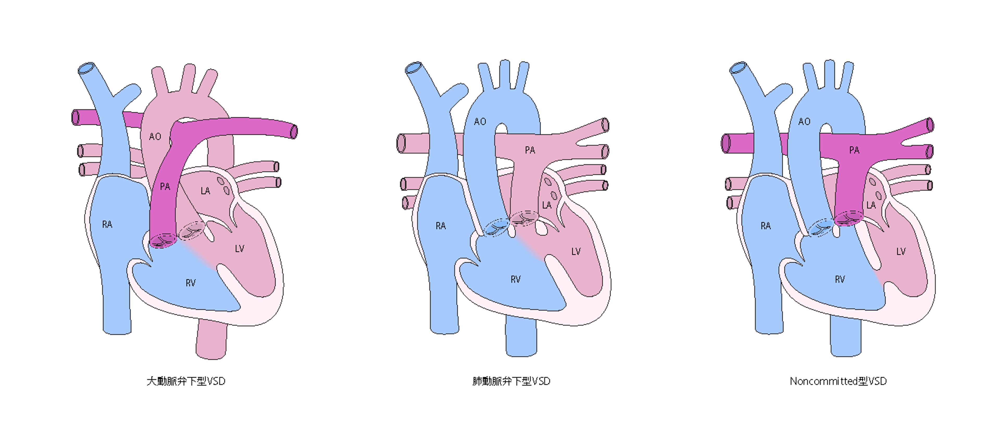 両大血管右室起始症（DORV）の主な病型