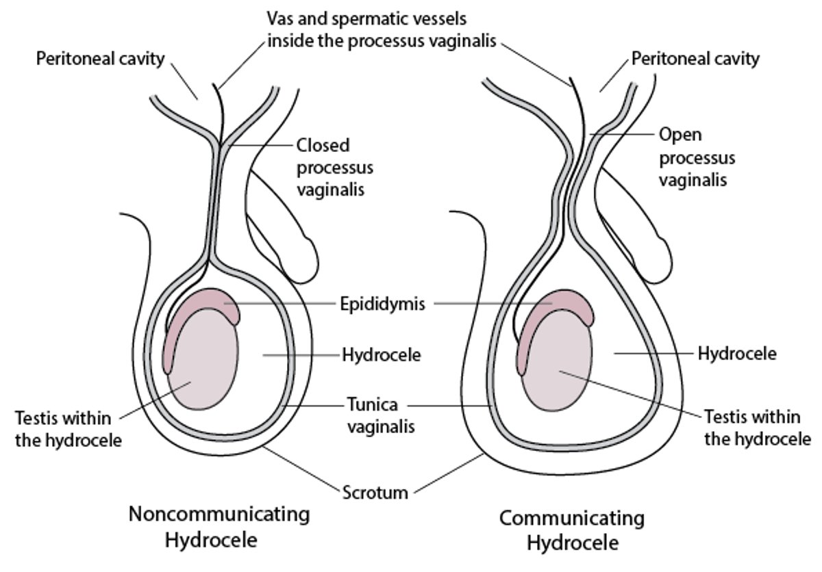Congenital Hydrocele