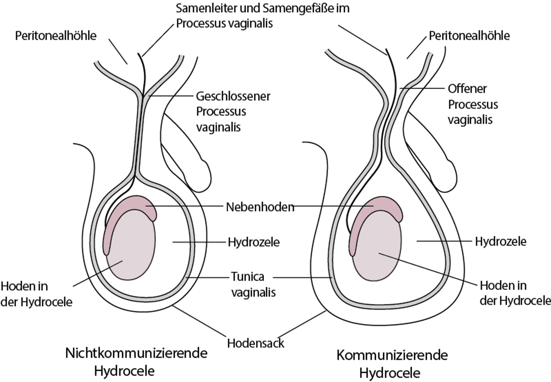 Angeborene Hydrozele