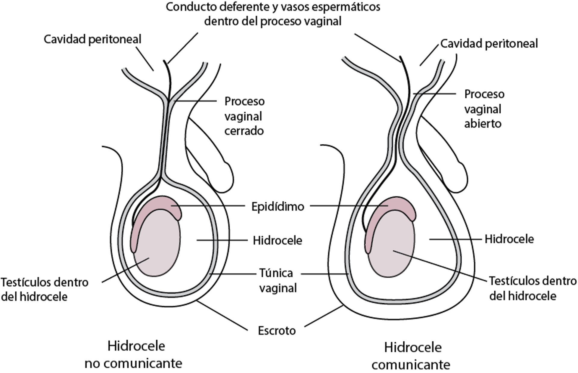 Hidrocele congénito