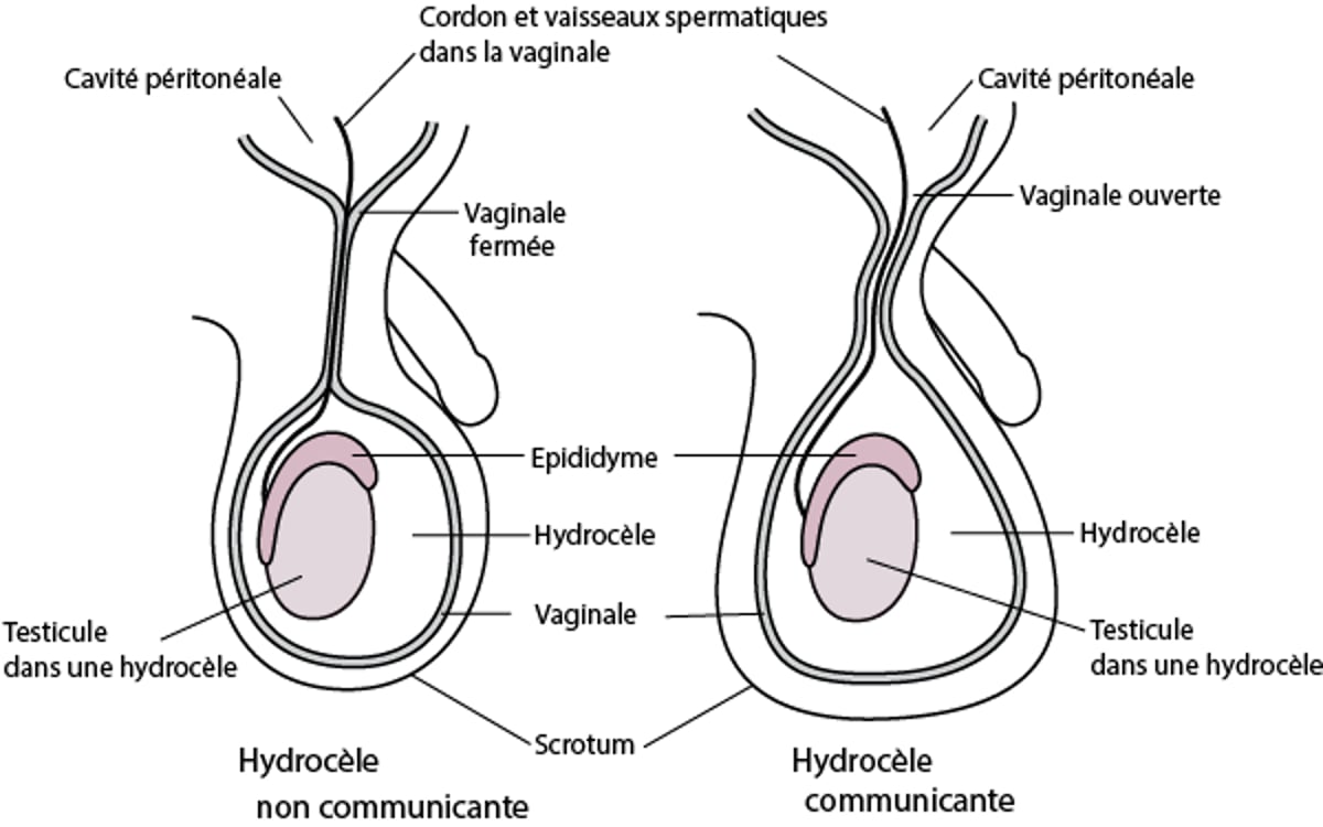 Hydrocèle congénitale