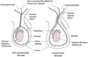 Idrocele congenito