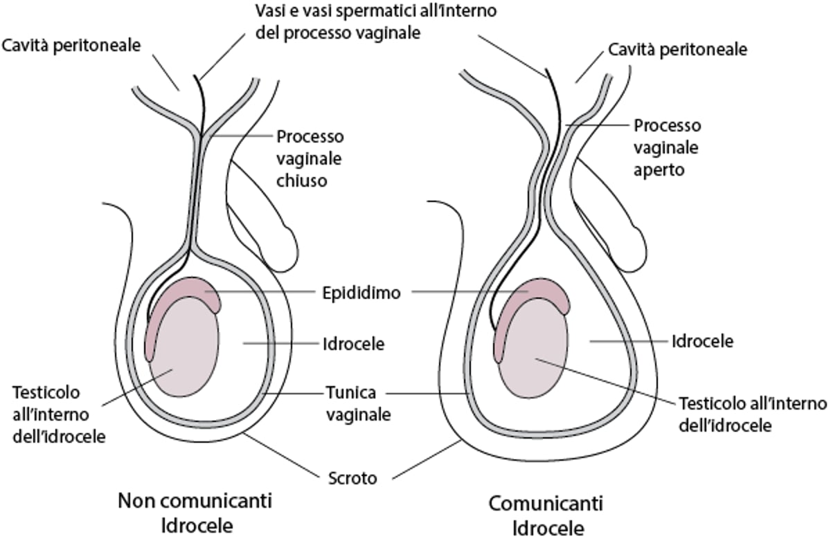 Idrocele congenito