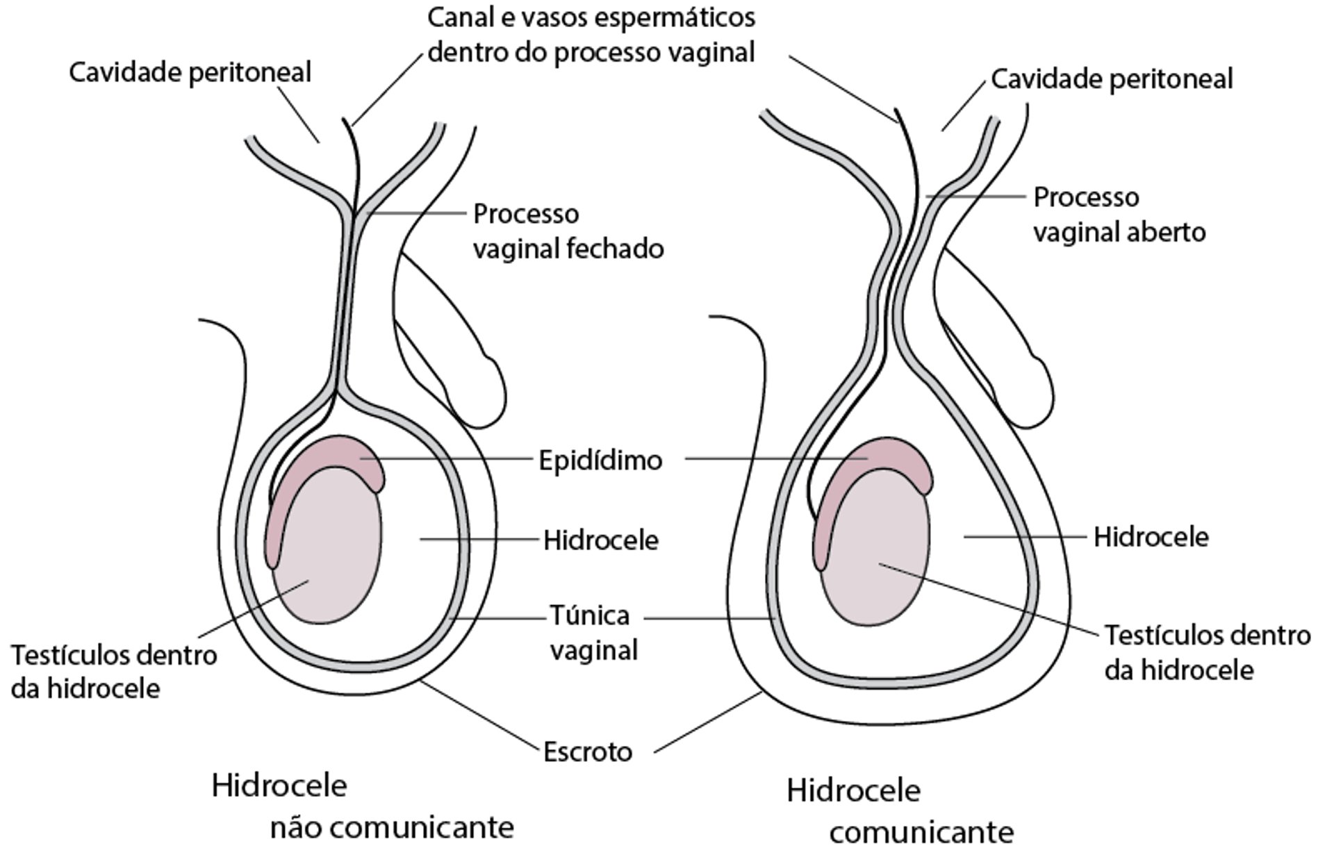 Hidrocele congênita