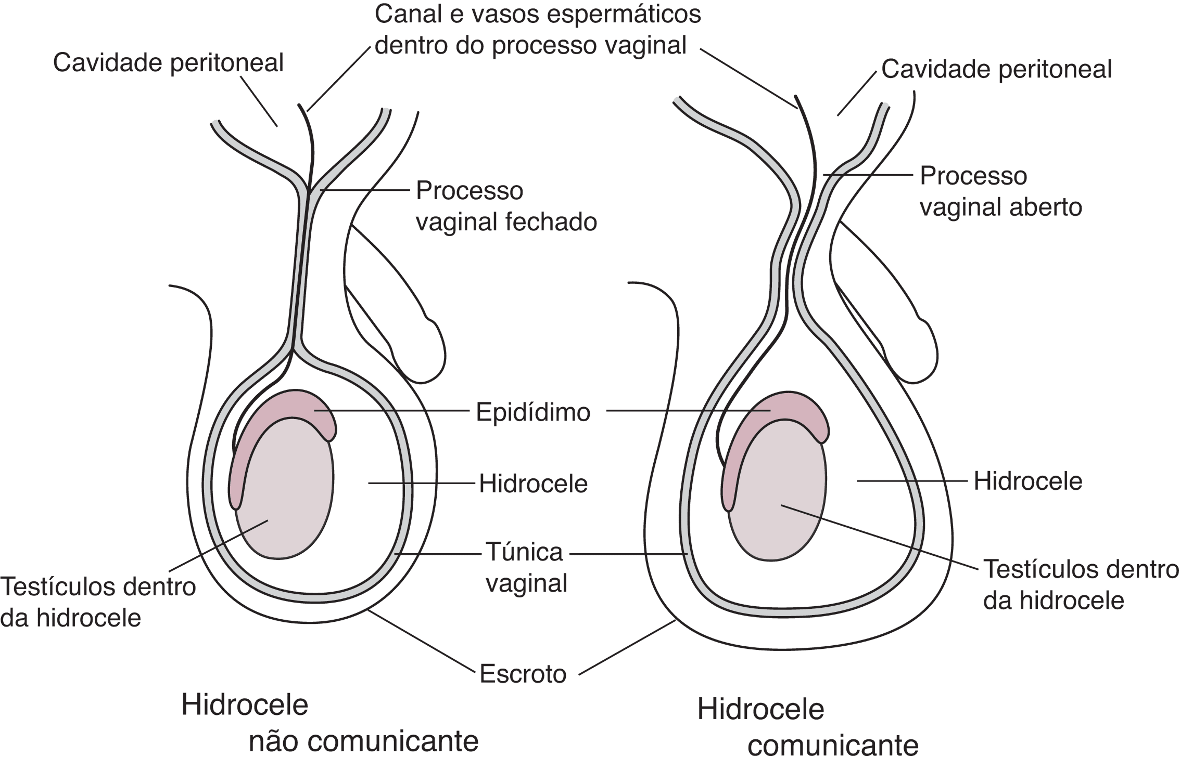 Hidrocele congênita