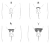 男児の陰毛発達に関するタナー段階（II～V）の模式図