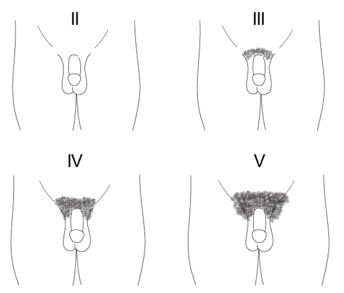 男児の陰毛発達に関するタナー段階（II～V）の模式図