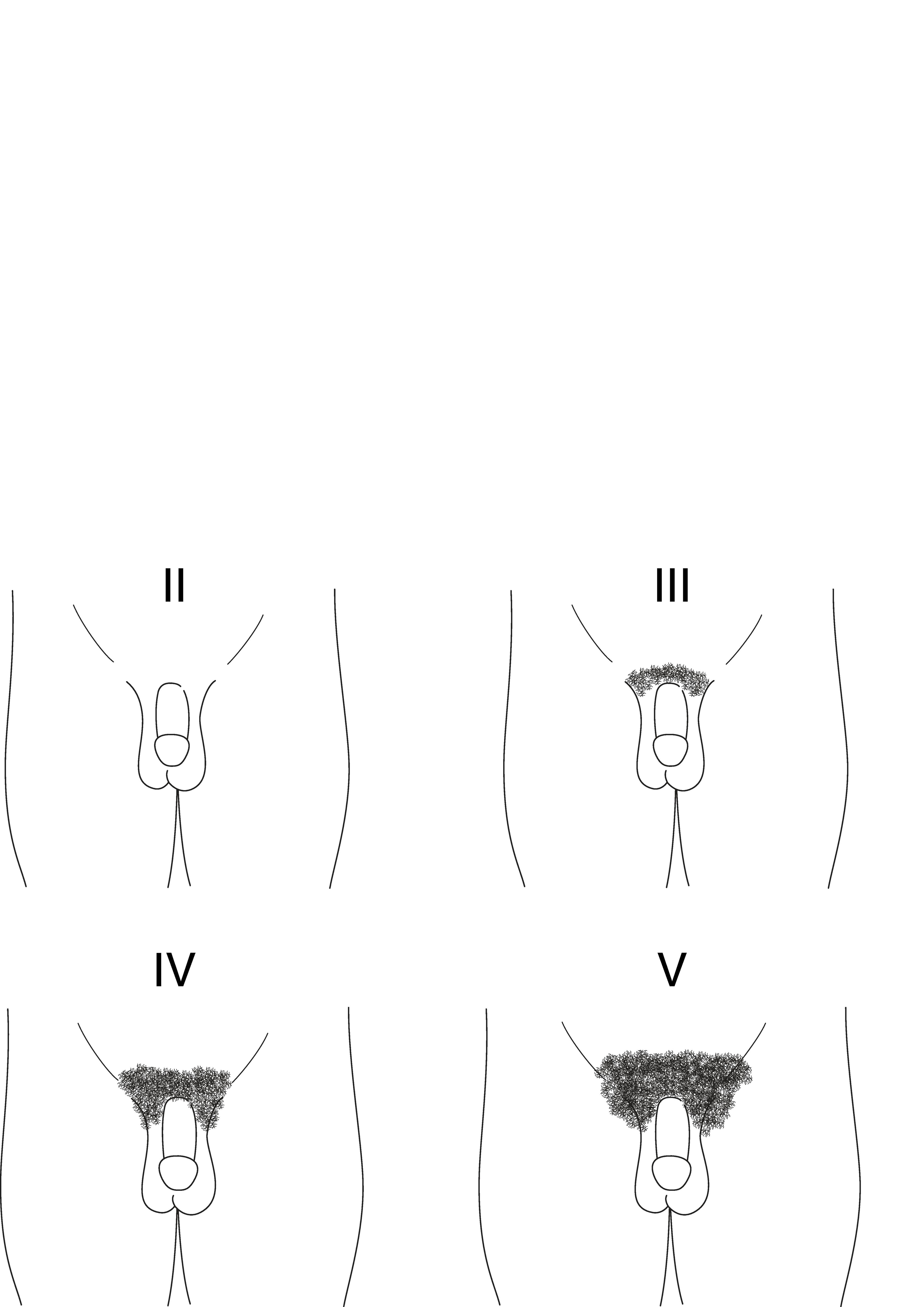 Diagrama dos estágios II a V de Tanner do desenvolvimento de pelo pubiano em meninos