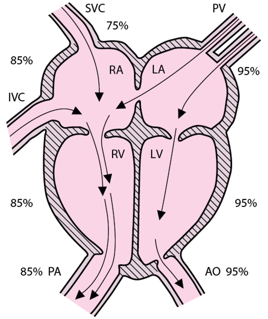 Atrial septal defect