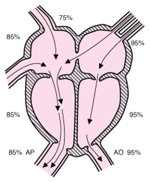 Defeito do septo atrial