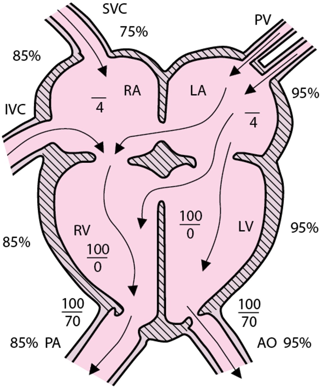 Atrioventricular septal defect (complete form)