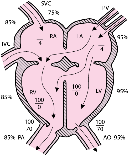 Atrioventricular Septal Defect - Pediatrics - MSD Manual Professional ...