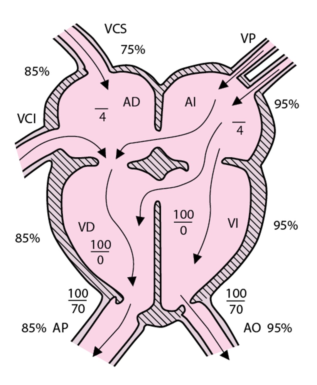 Comunicación auriculoventricular (forma completa)