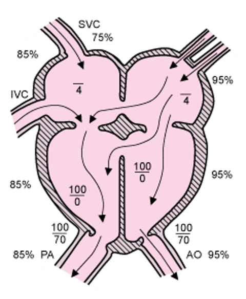 房室中隔欠損症（完全型）