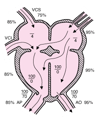 Defeito no septo atrioventricular (forma completa)