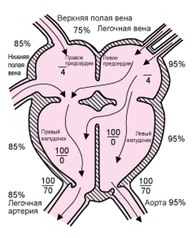 Атриовентрикулярной дефект межпредсердной перегородки (полная форма)
