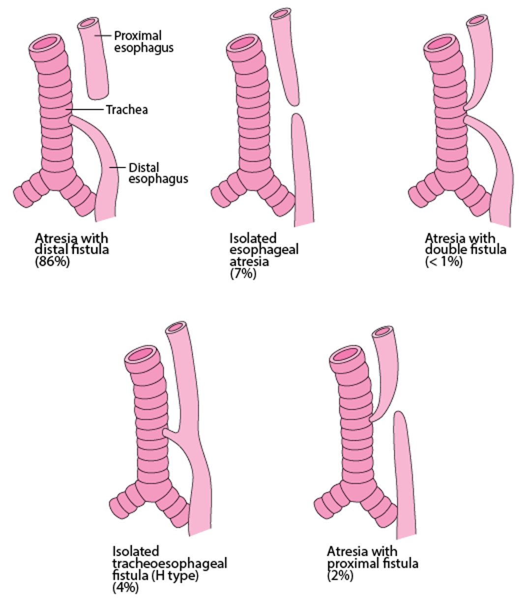 Types and Relative Frequencies of Esophageal Atresia and Tracheoesophageal Fistula