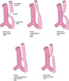 Types et fréquences relatives des atrésies de l'œsophage et des fistules trachéo-œsophagiennes