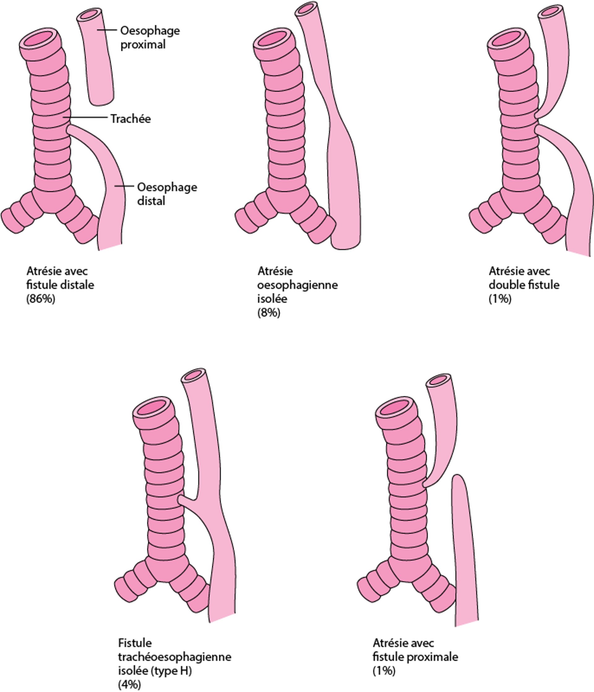Types et fréquences relatives des atrésies de l'œsophage et des fistules trachéo-œsophagiennes