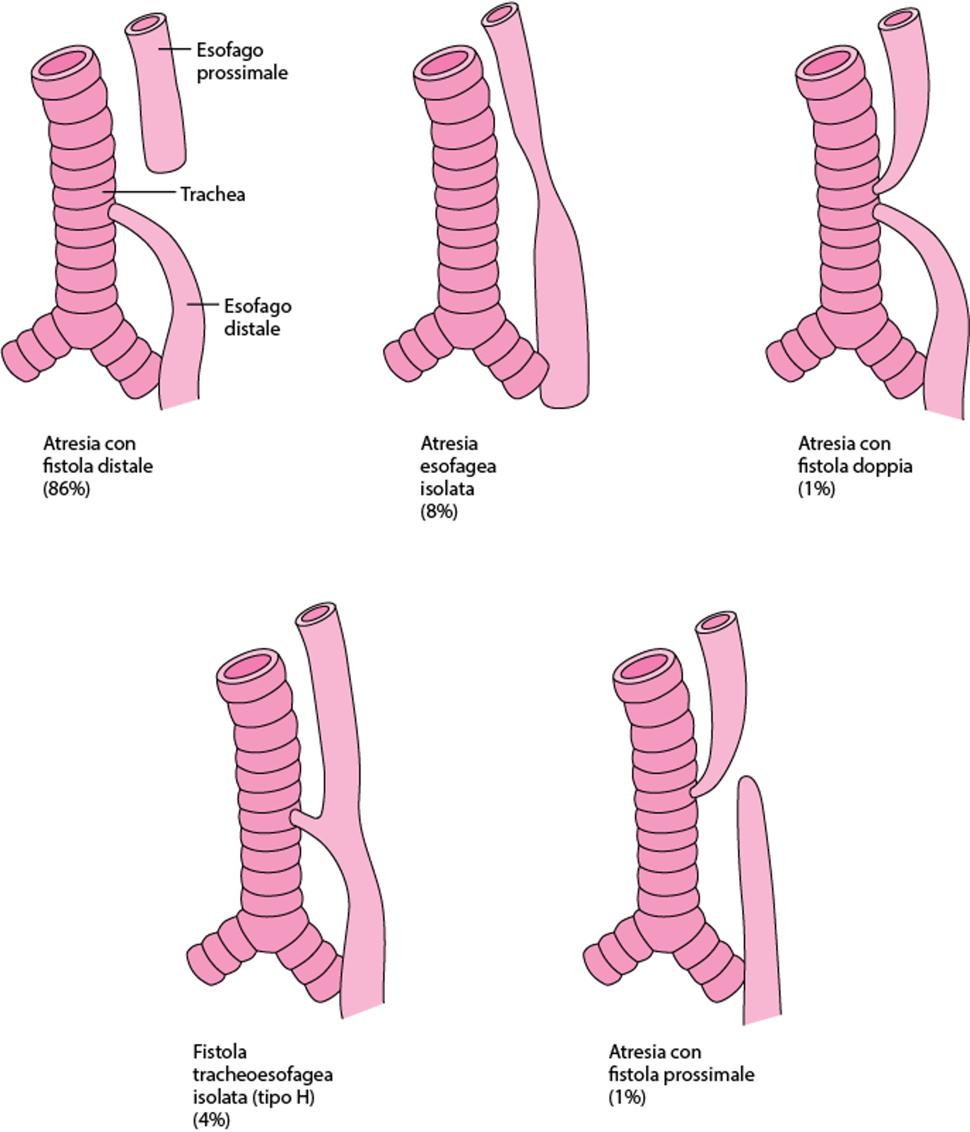 Tipi e incidenza relativa delle atresie esofagee e delle fistole tracheoesofagee