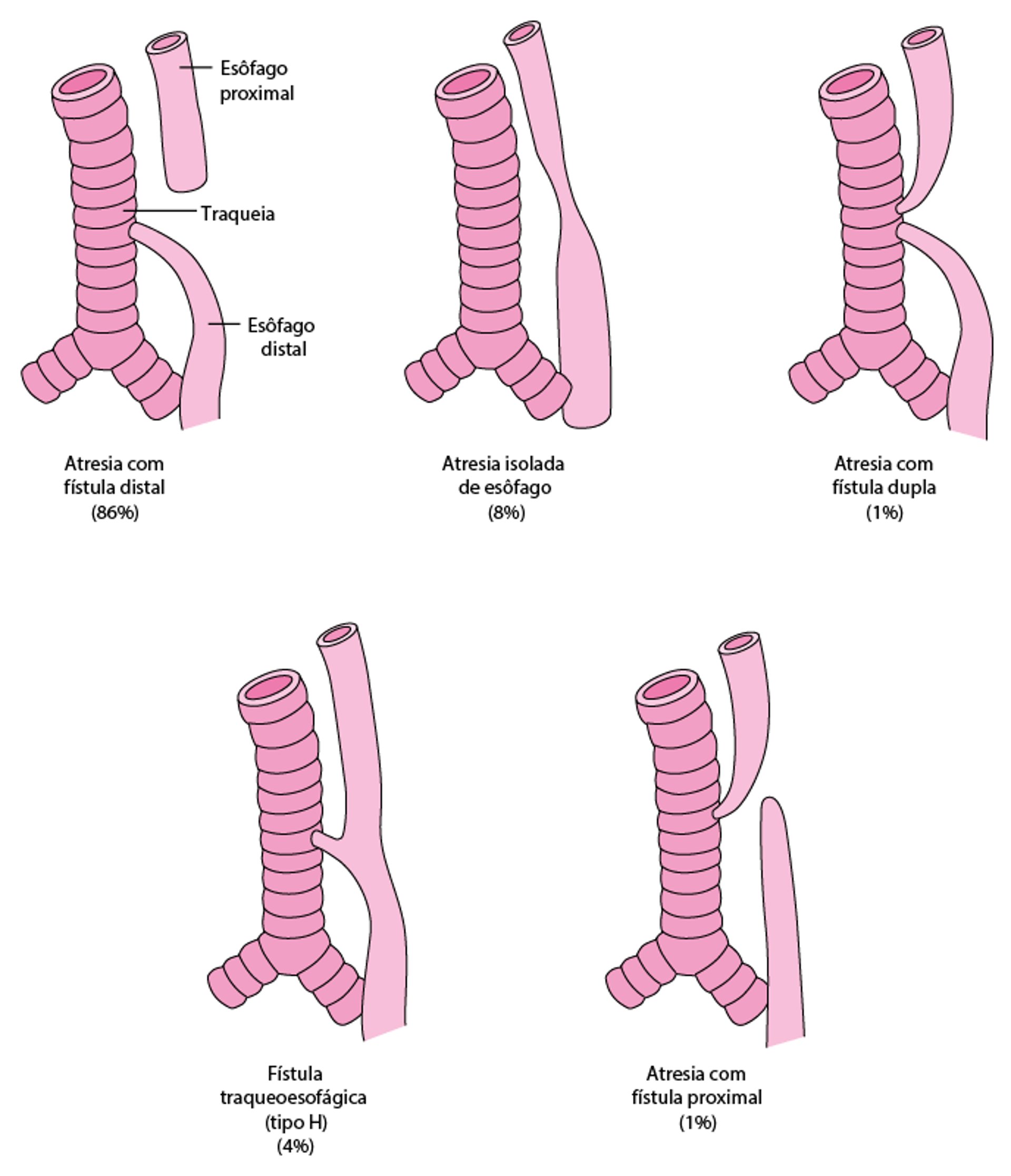 Tipos e frequências relativas da atresia esofágica e fístula traqueoesofágica