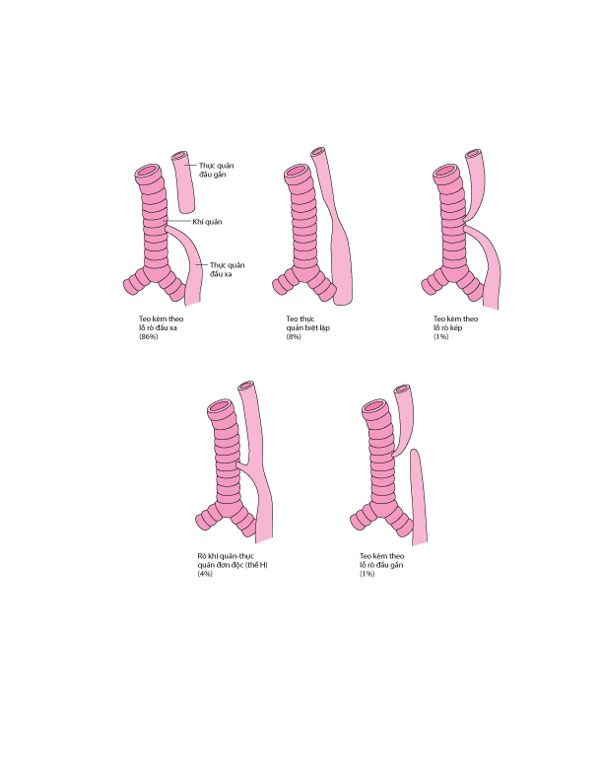 Các loại và tần suất tương đối của hẹp thực quản và rò khí quản thực quản