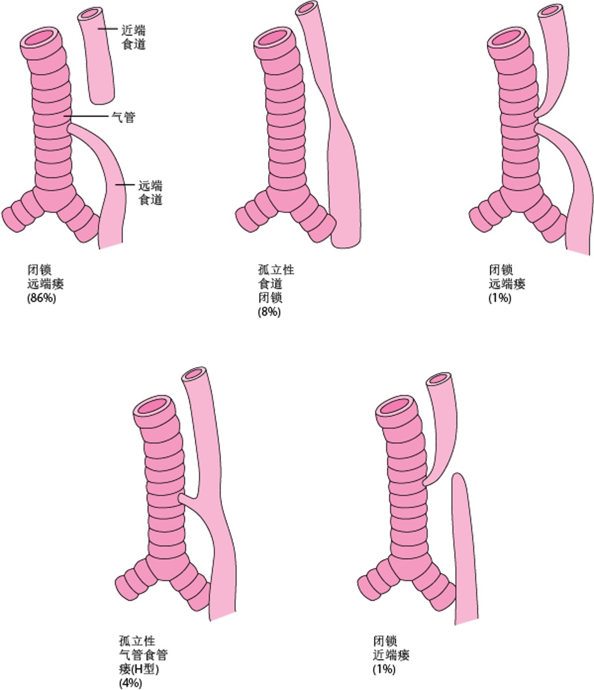 食管闭锁及气管食管瘘的类型和相对频率