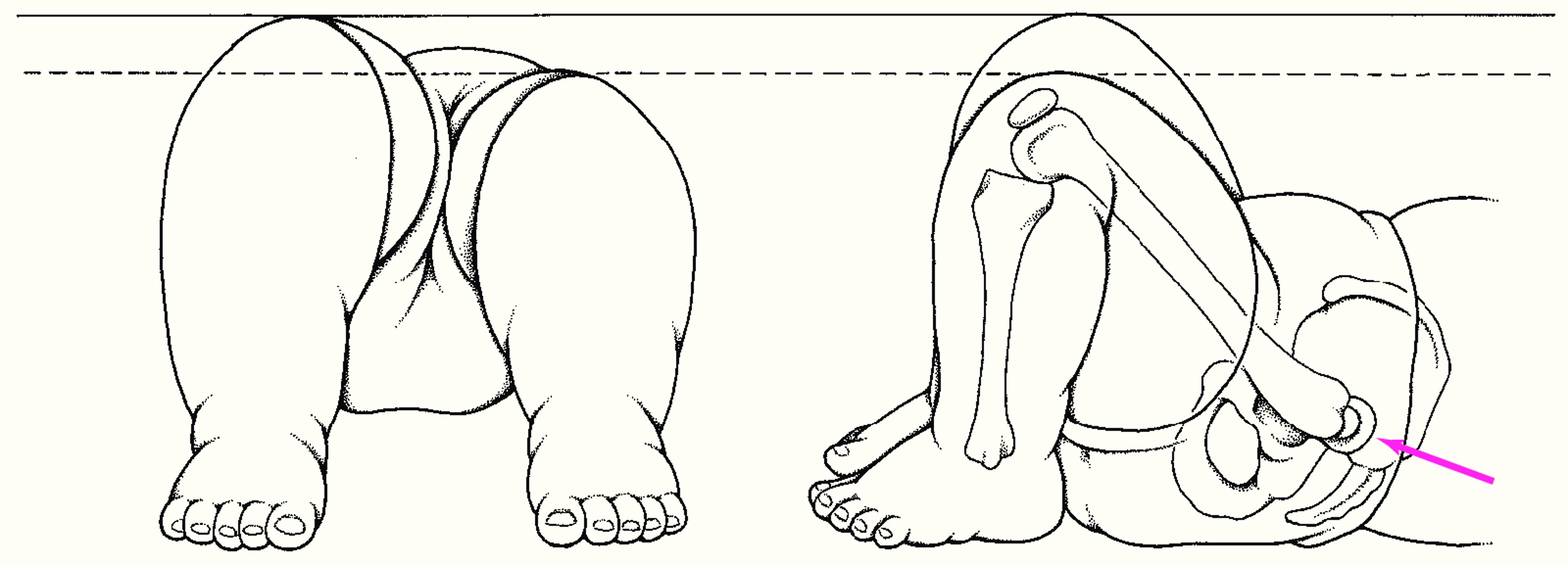 Dấu hiệu Galeazzi Sign