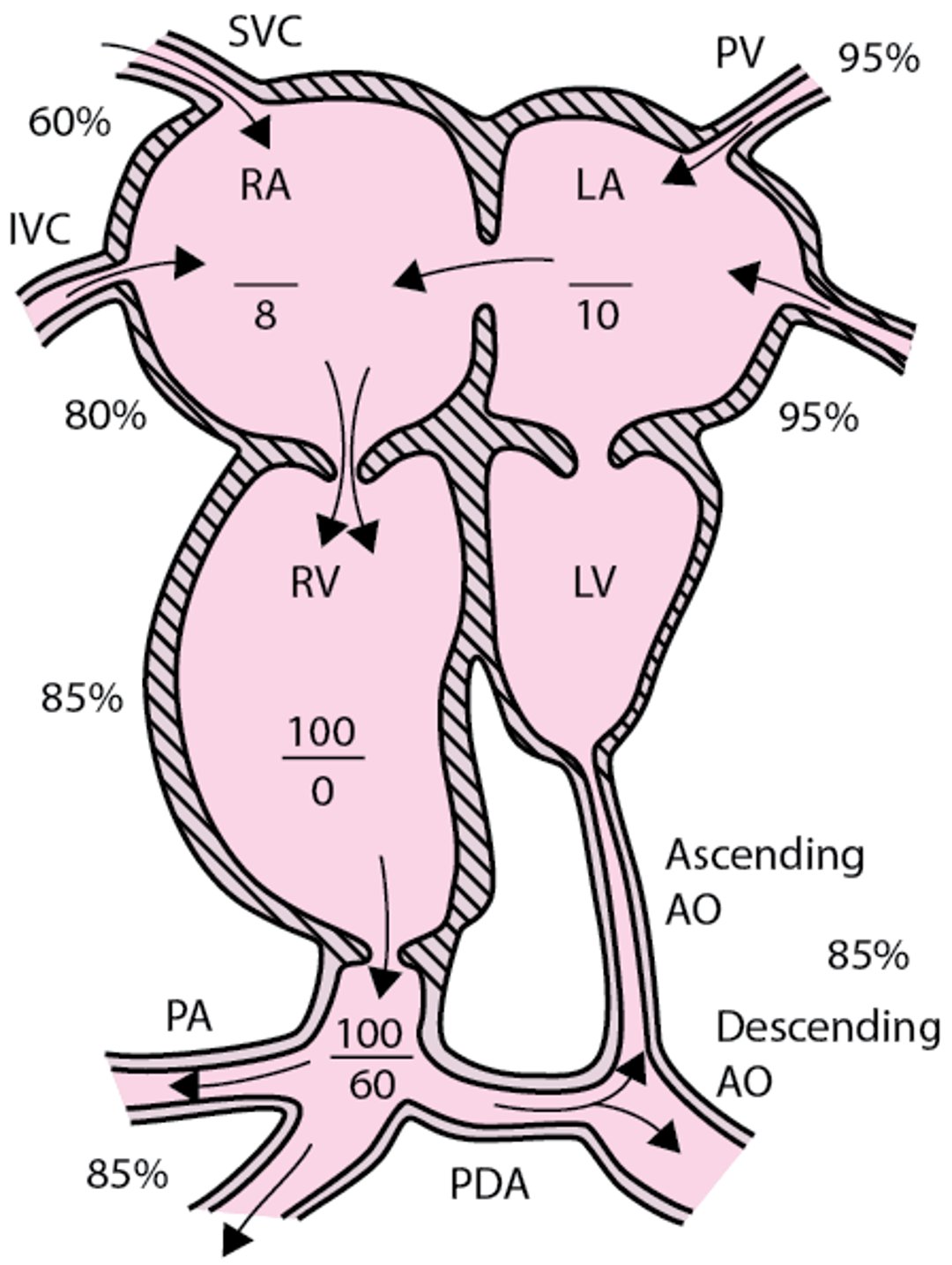 Hypoplastic left heart