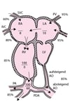 Hypoplastisches linkes Herz