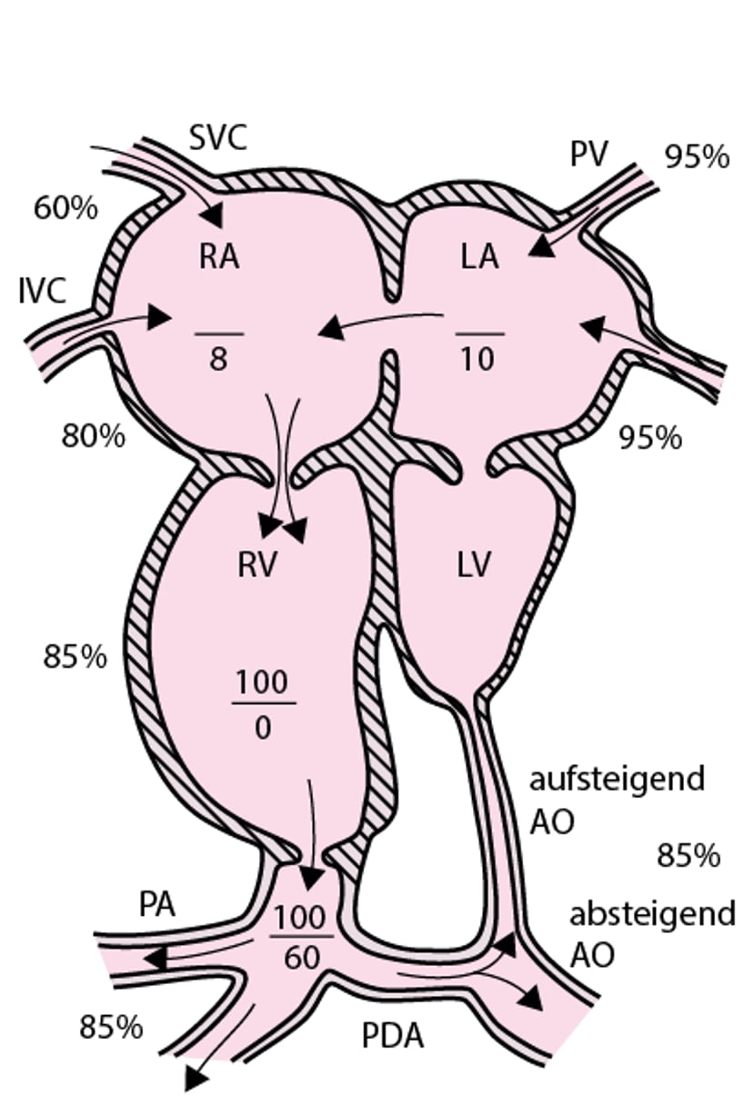 Hypoplastisches linkes Herz