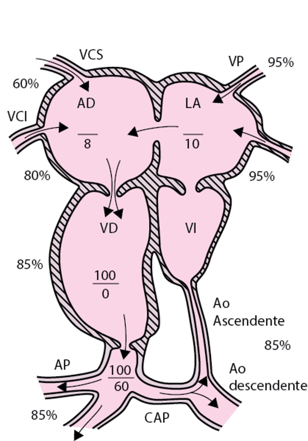 Hipoplasia del corazón izquierdo