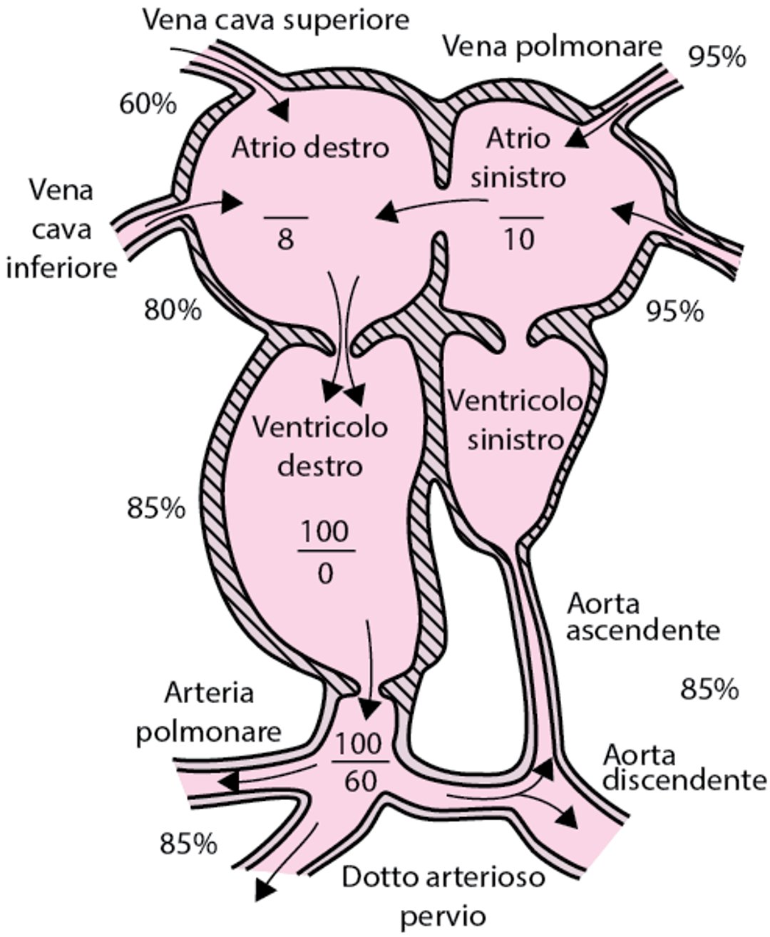 Cuore sinistro ipoplasico