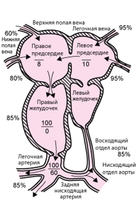 Гипоплазия левых отделов сердца