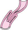 Intususcepción