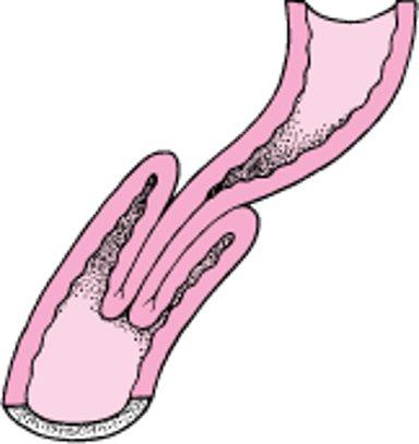 腸重積症