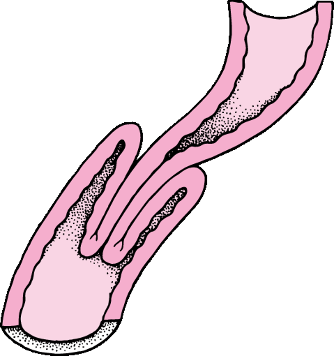 Lồng ruột