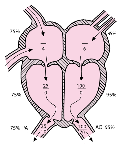 Tuần hoàn bình thường với áp suất tim phải và trái (mmHg).