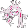Persistierender Ductus arteriosus