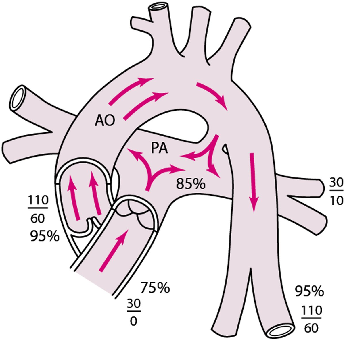 Persistierender Ductus arteriosus