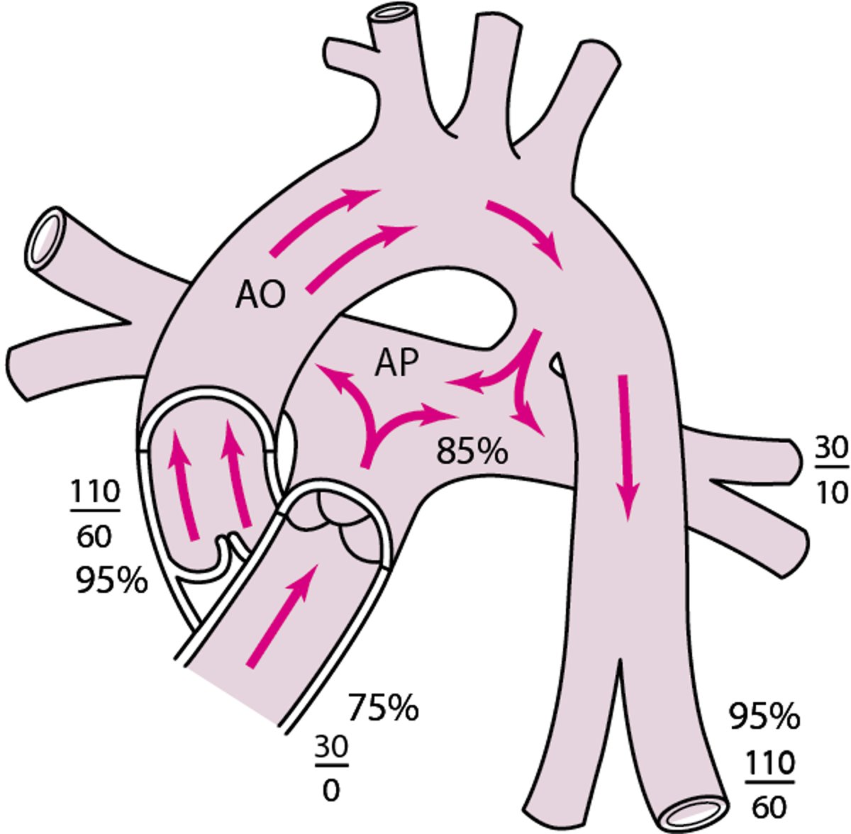 Conducto arterioso permeable