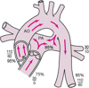 動脈管開存症