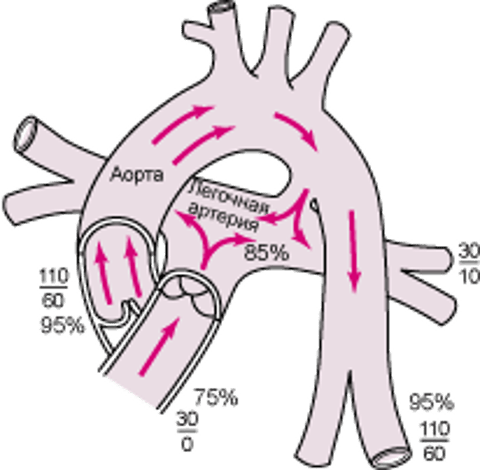 Открытый артериальный проток