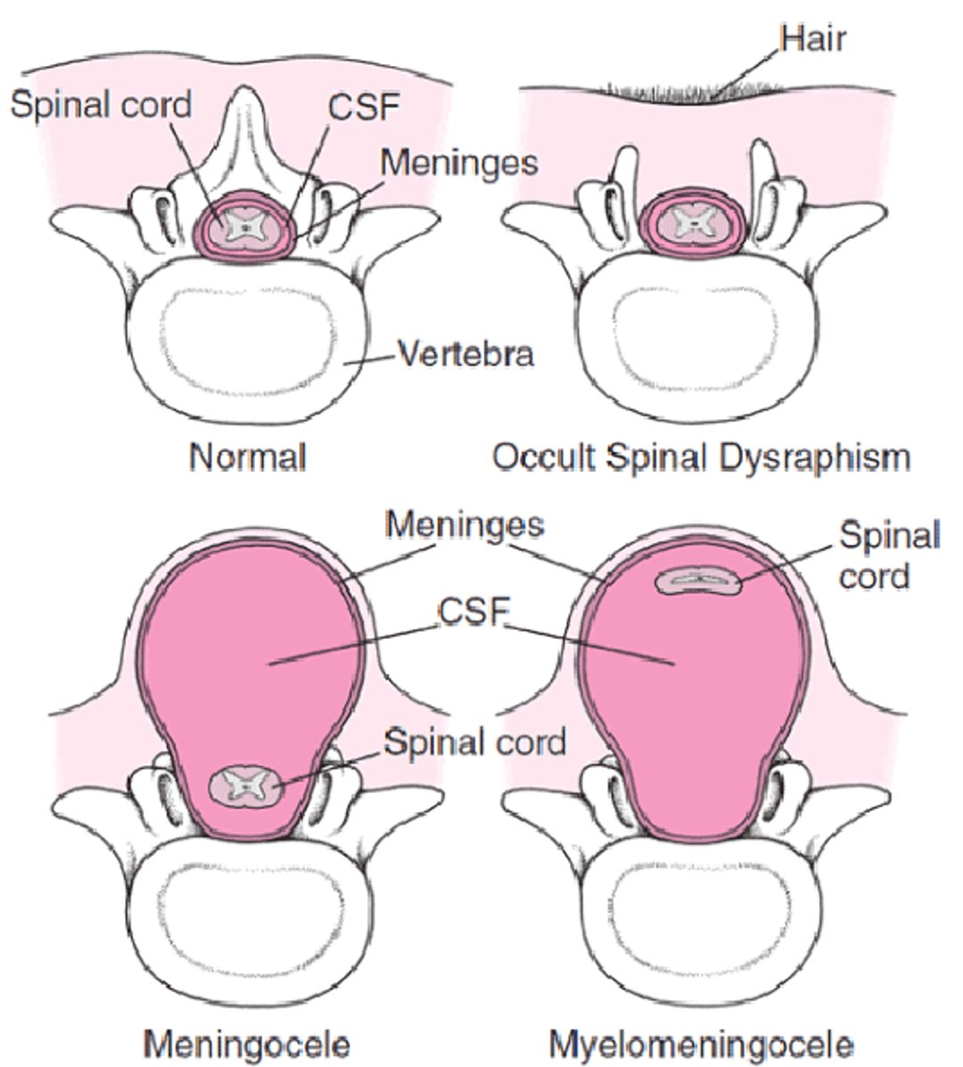 Forms of Spina Bifida