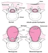 Formen der Spina bifida