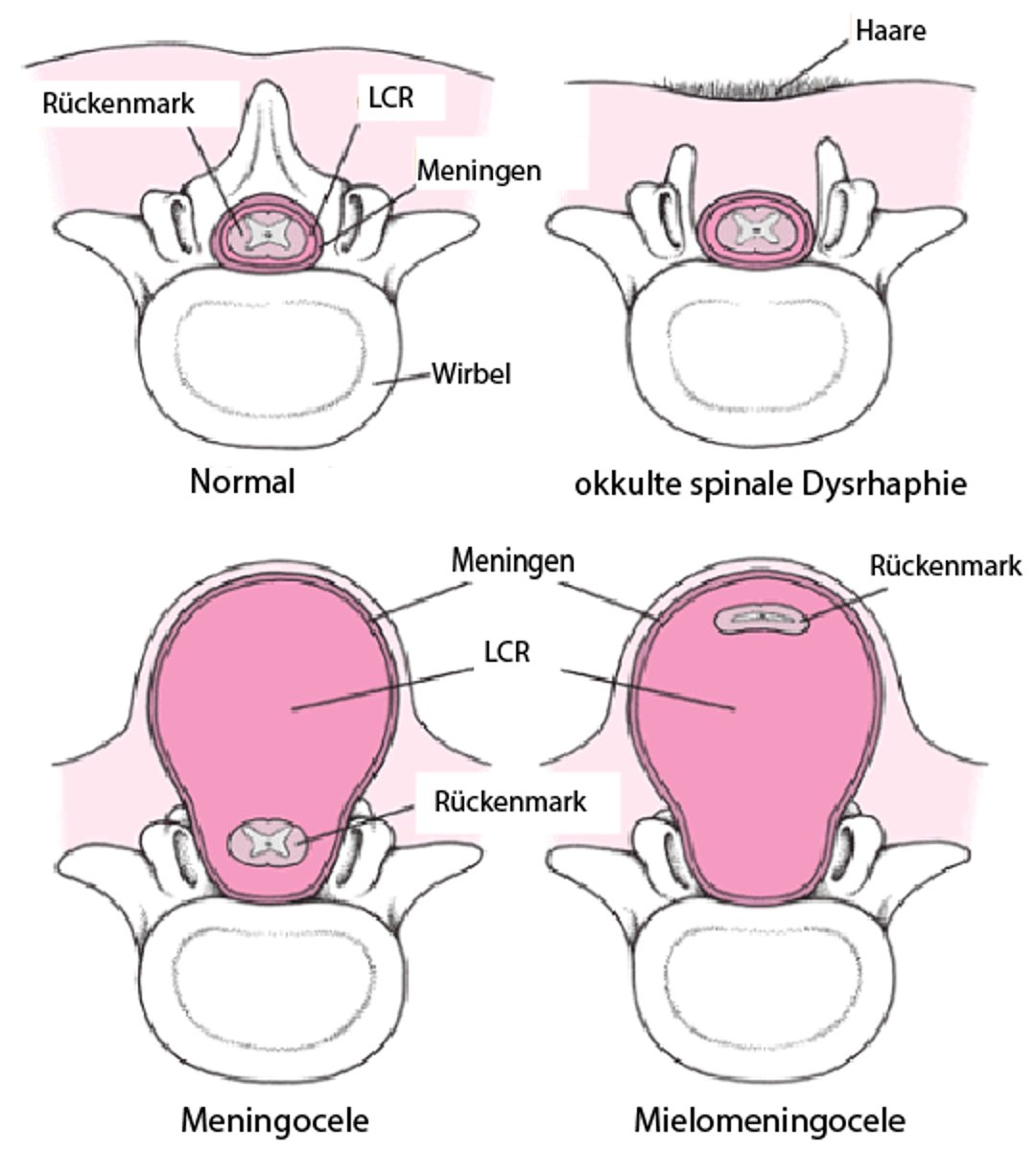 Formen der Spina bifida
